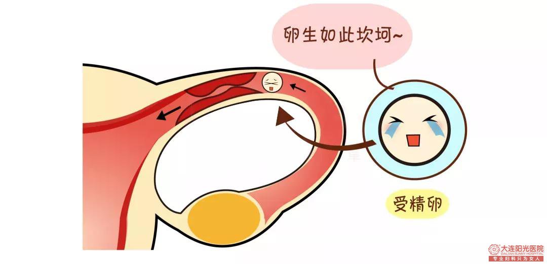宁德宫外孕：善于伪装、随时引爆、不能预防 