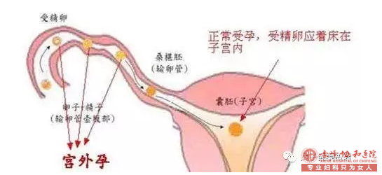 宁德阿鲁科尔沁旗八种宫外孕高危人群