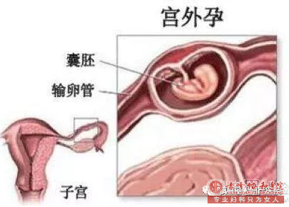 宁德格日僧卫生院宫外孕怎么办呢