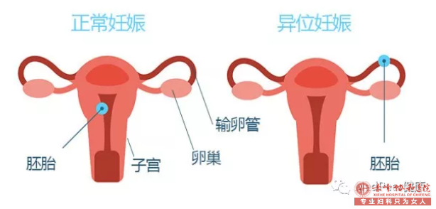 宁德元宝山区宫外孕的治疗方法都有哪些呢?